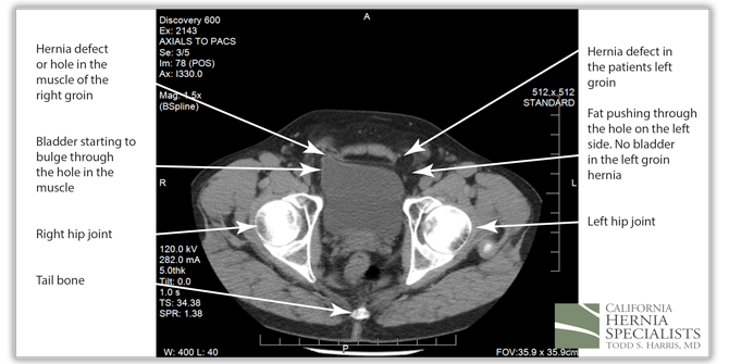 Initial hernia defect